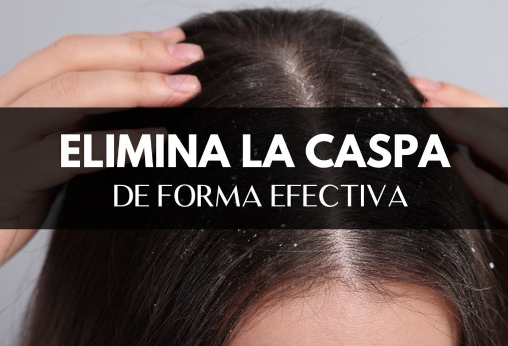 Cómo eliminar la caspa de forma efectiva